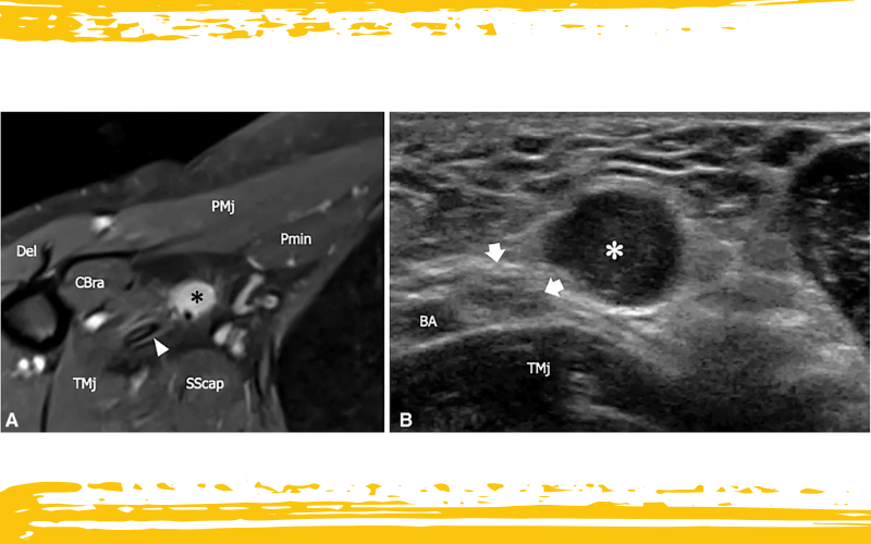 4. Nervio intercostobraquial y nervio cutaneo medial del brazo.png